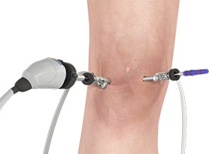 Arthroscopy of the Knee Joint