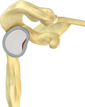 Labral Repair