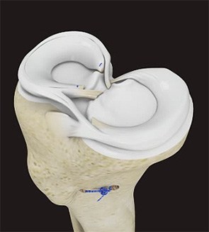 Meniscus Repair