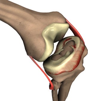 Meniscal Tears