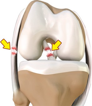 Multi-ligament Injuries