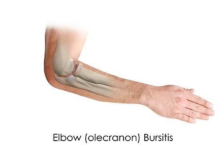 Elbow (Olecranon) Bursitis