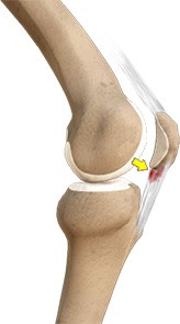 Patellar Tendinitis