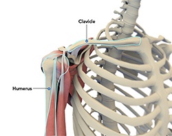 Shoulder Replacement